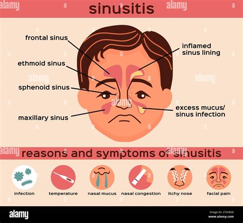 sinisita in english